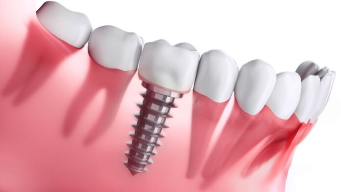 Dentistry for Dental Implants