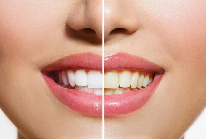 Teeth whitening services in Flagstaff, AZ